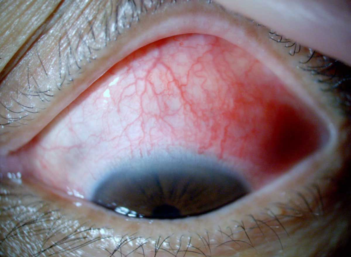 眼表面の疾患